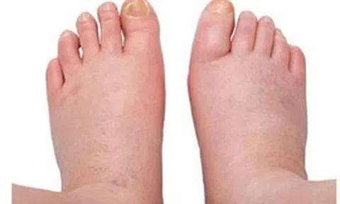 Phù chân khi nào lành tính, khi nào cảnh báo bệnh lý nguy hiểm?