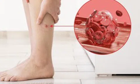 Bất kể giới tính, nếu điều này xuất hiện trên chân, đó có thể là dấu hiệu của cục máu đông trong cơ thể