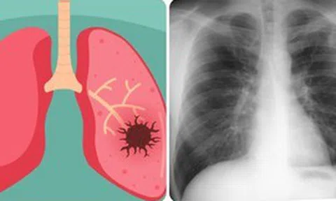 9 dấu hiệu ung thư phổi giai đoạn đầu