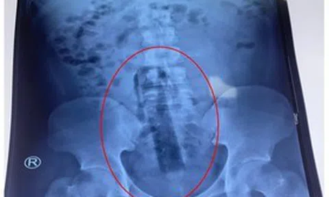 Nam thanh niên nhập viện vì sự cố hy hữu với vật dụng vệ sinh
