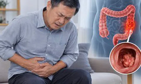 Bác sĩ chỉ: 6 DẤU HIỆU cảnh báo ung thư ruột, nhiều người nhầm tưởng là "rối loạn tiêu hóa"