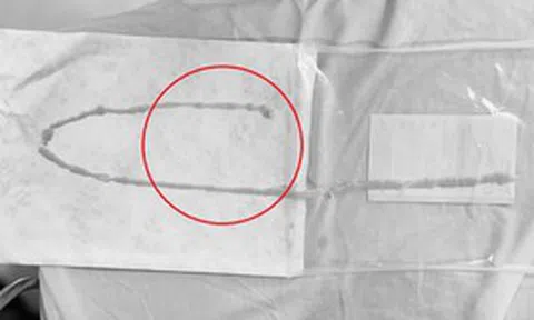 Người phụ nữ 48 tuổi sốc khi bác sĩ gắp ra thứ "đáng sợ" bên trong bụng
