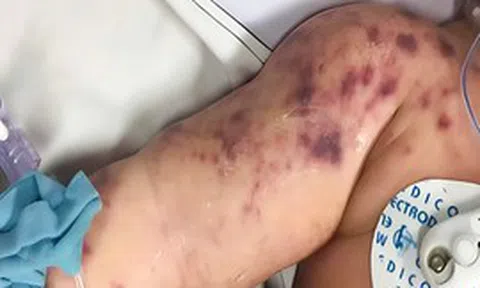 Bệnh nhi 8,5 tháng tuổi mắc não mô cầu, hoại tử chi sau vài giờ nhập viện: “Một ca thôi đã là quá đủ”